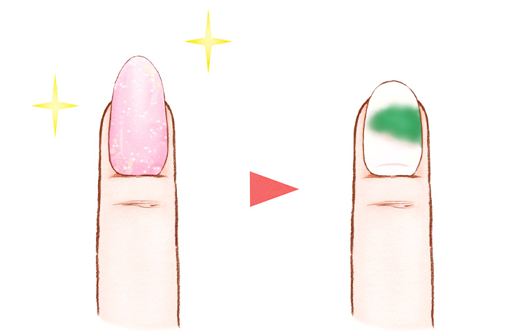 グリーンネイル（緑膿菌感染症）のイラスト
